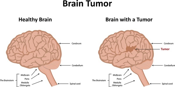 Brain Tumor Surgery