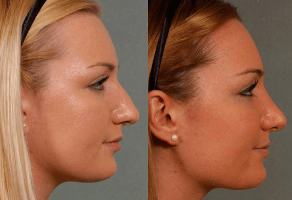 Before and After Rhinoplasty