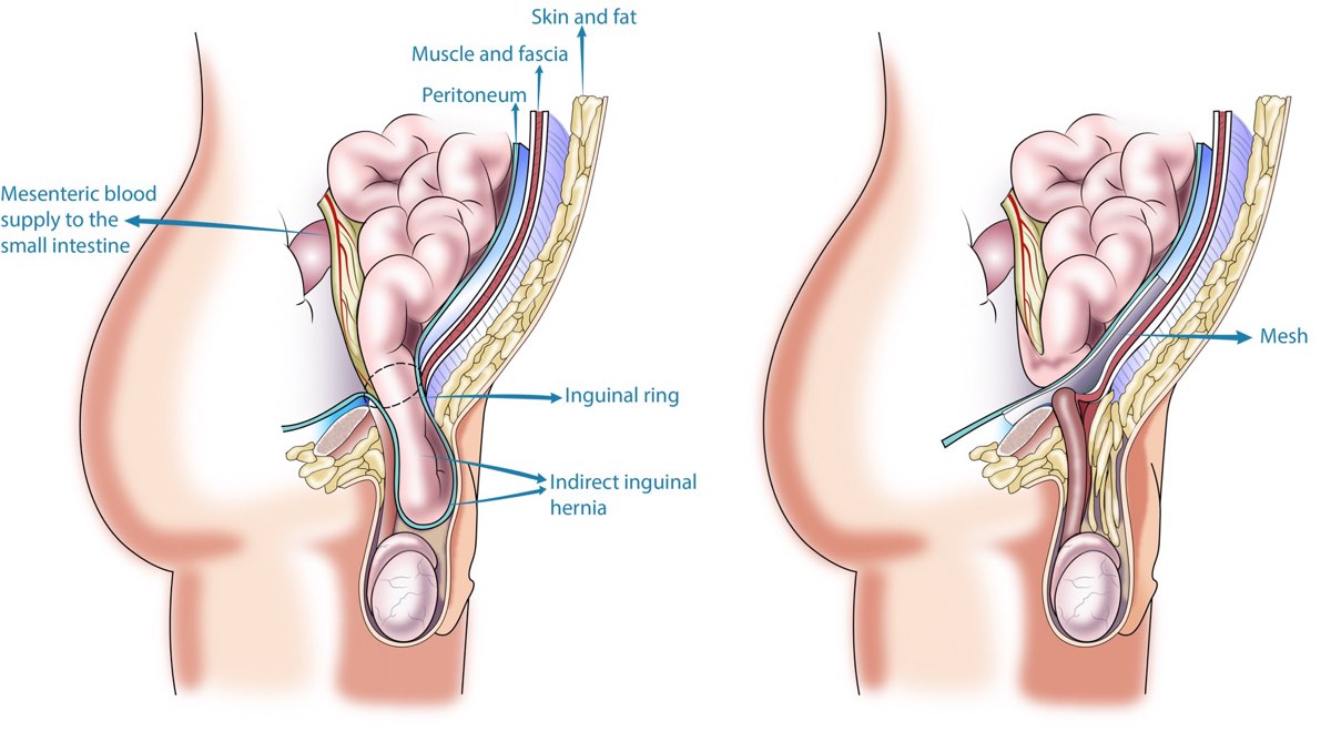 Hernia Repair Procedure