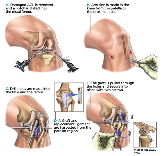 Knee Ligament Surgery